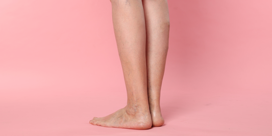 Swollen legs in pregnancy and tips to managing swelling in pregnancy